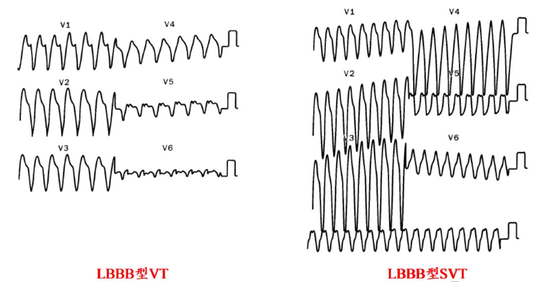 心电图上表现为宽qrs波,心电图中qrs是代表心动过速吗