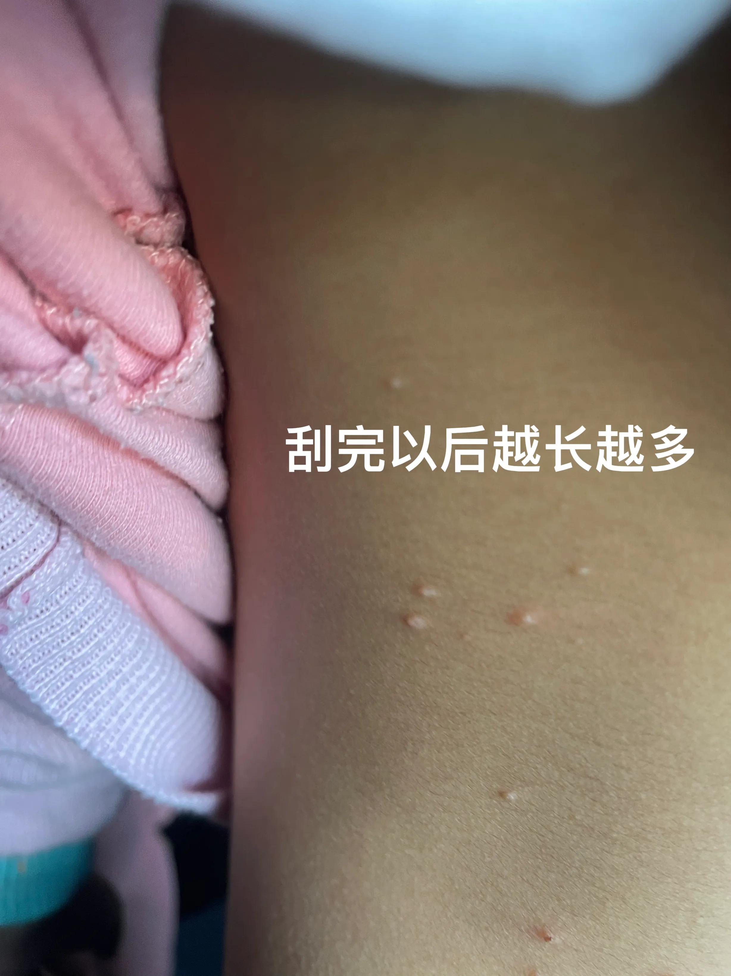 包皮传染性软疣自愈,传染性软疣多久可以自愈