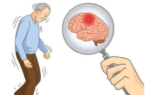 提醒：无端端有3种表现，十有八九是脑梗“求救”信号，尽早检查