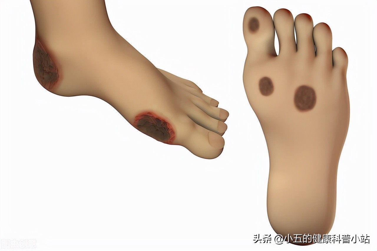 糖尿病长期吃药肾受损怎么办,糖尿病如何损伤血管的