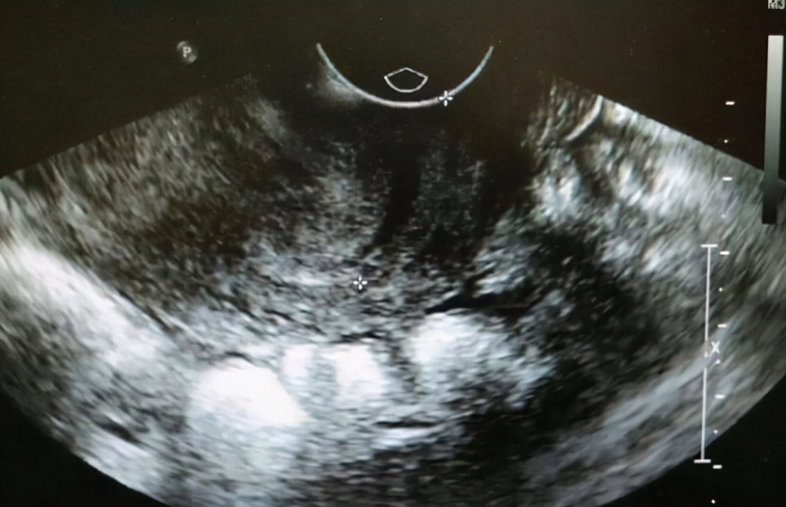 有个小囊肿要注意什么,医生诊断囊肿就一定是囊肿吗