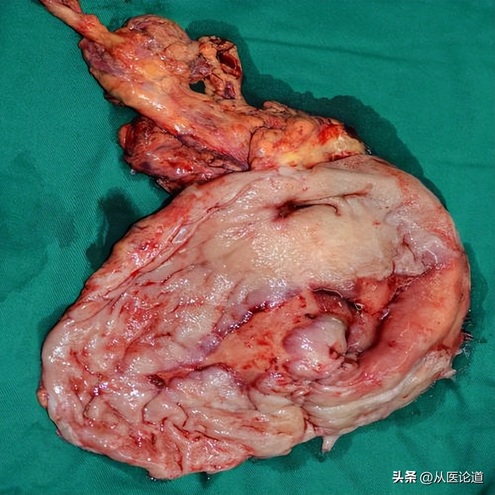 胃癌转移淋巴哪个部位,胃癌侵犯浆膜淋巴转移