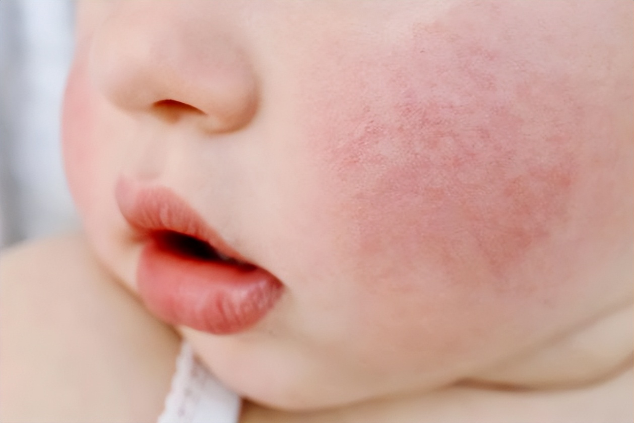 宝宝湿疹一直反复怎么断根,宝宝湿疹反反复复如何彻底根除