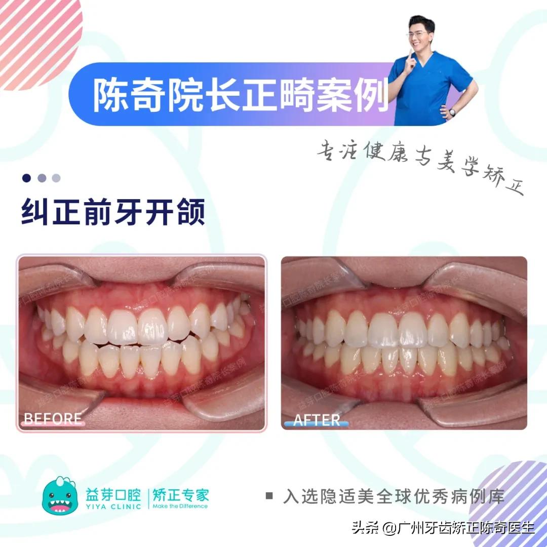 隐适美矫正和普通矫正的区别,隐适美矫正有几种版本