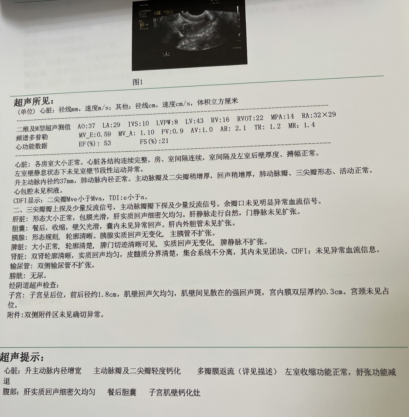 一女子睡觉半夜咳嗽发现子宫脱垂,咳嗽会引起子宫脱垂吗