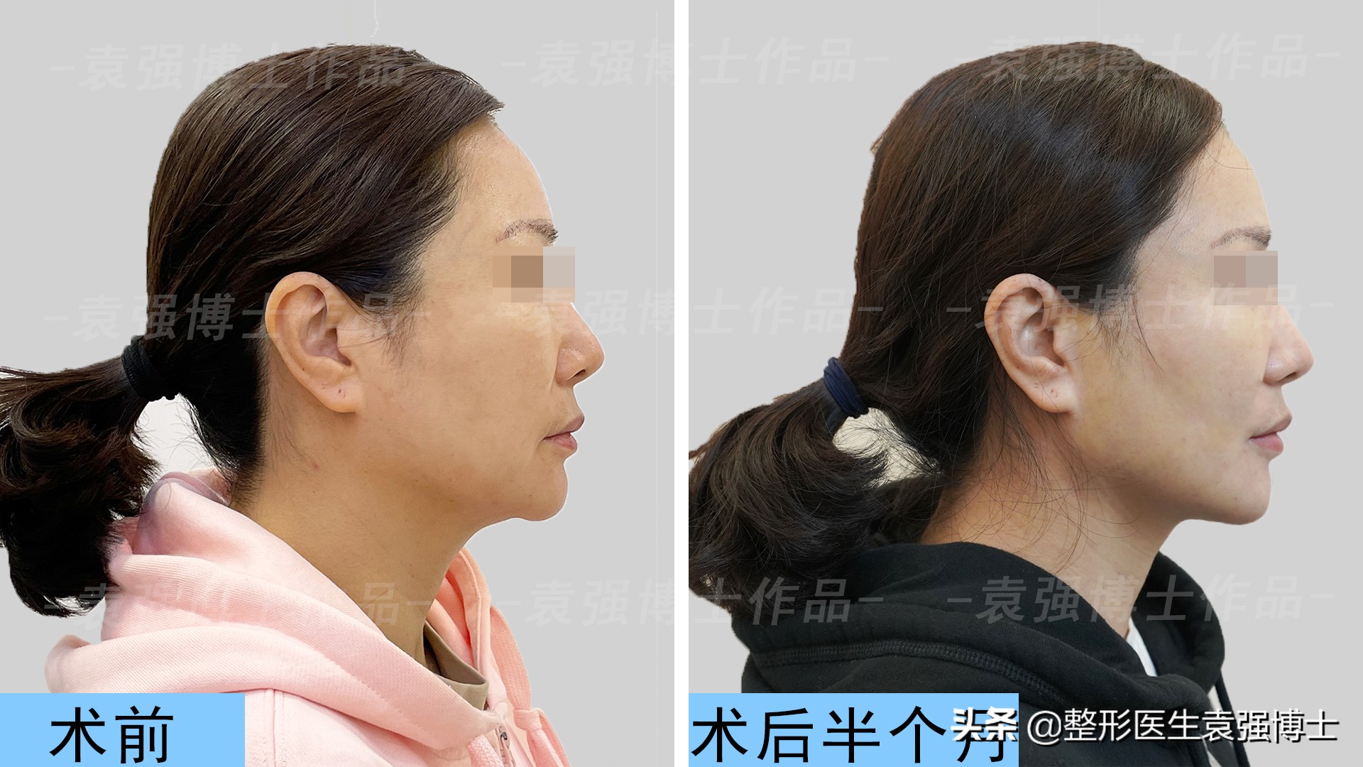 下颌缘拉皮提升前后对比图,小拉皮能改善下颌线吗