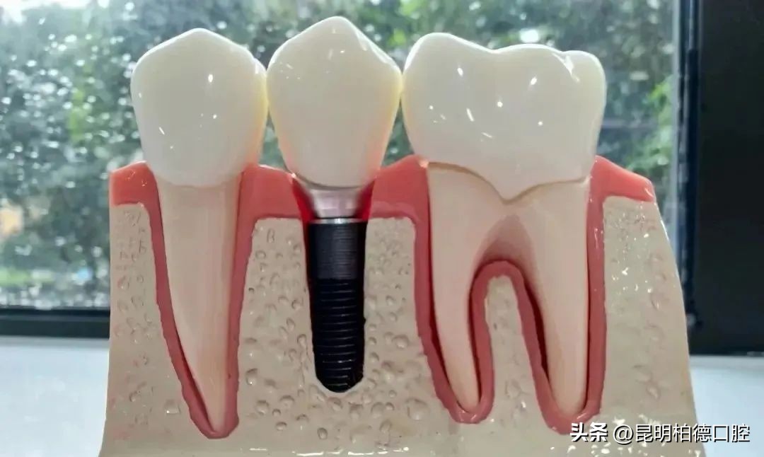 种植牙后还能吸烟吗,刚做了种植牙能吸烟吗