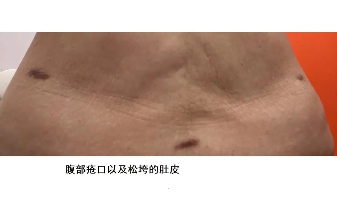 愁！花4万多元抽脂，留下12个疤，女子多次投诉厦门华美医疗