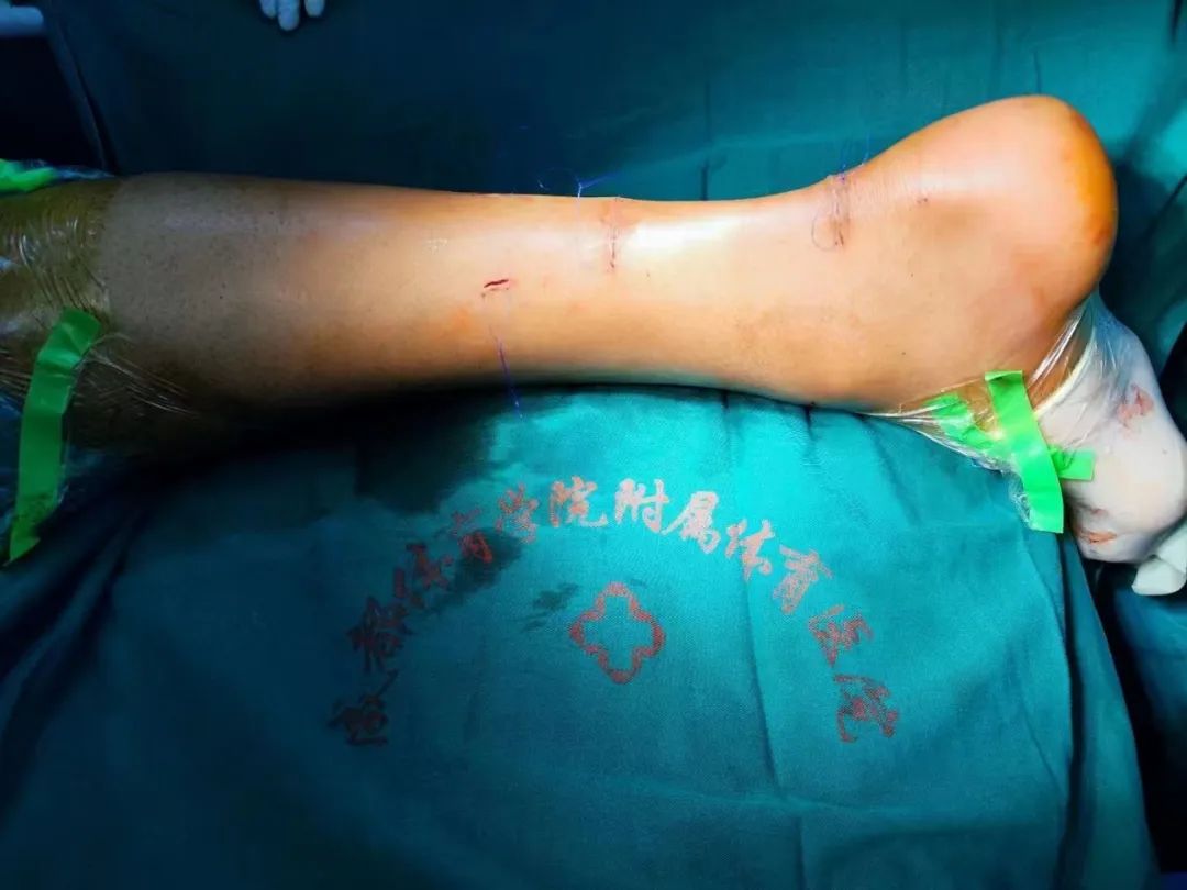 哈达迪姚明亚洲第一中锋,哈达迪跟腱断裂