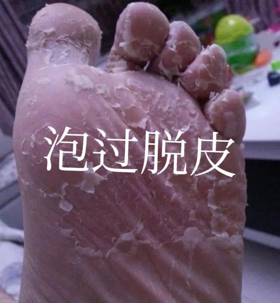 用过足光散后一直脱皮不好,用了足光散脱皮正常吗