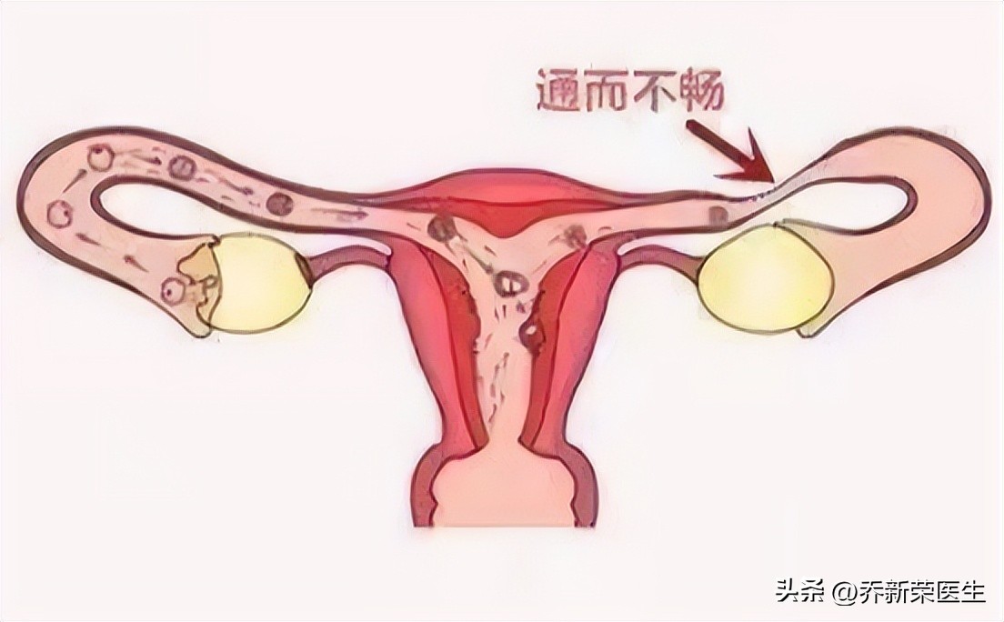 输卵管造影能疏通输卵管吗,输卵管造影可以疏通输卵管吗