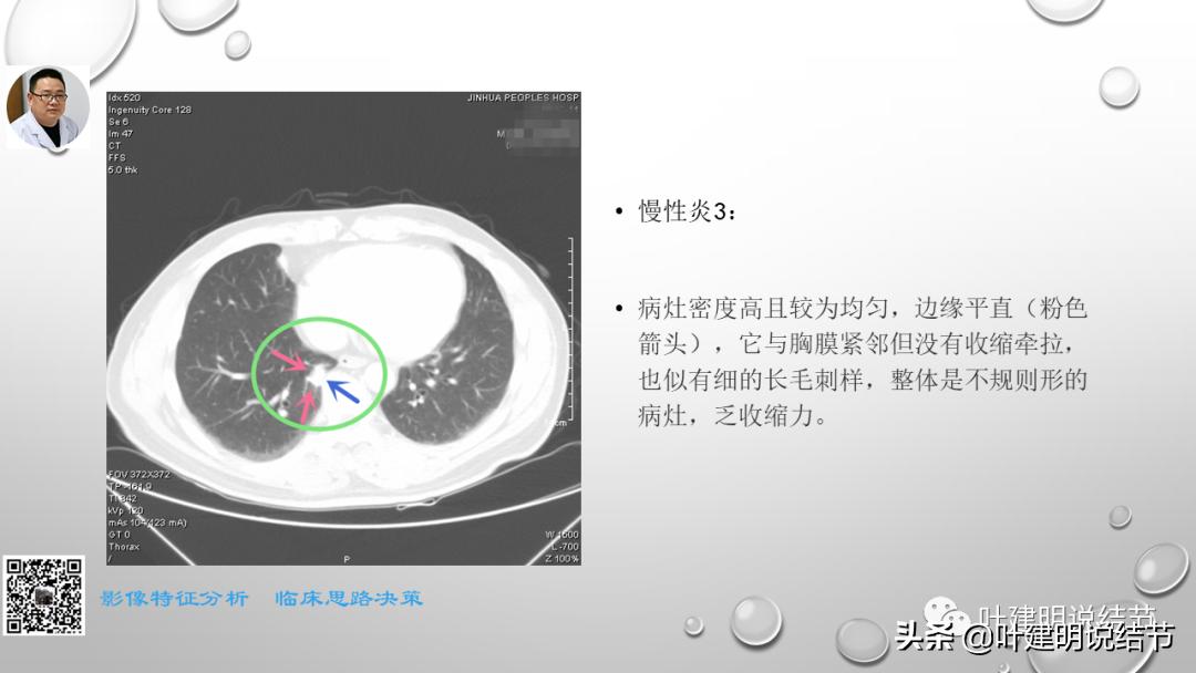 在《一脉阳光》呼吸影像诊断专题培训班上的讲课PPT（第一部分）