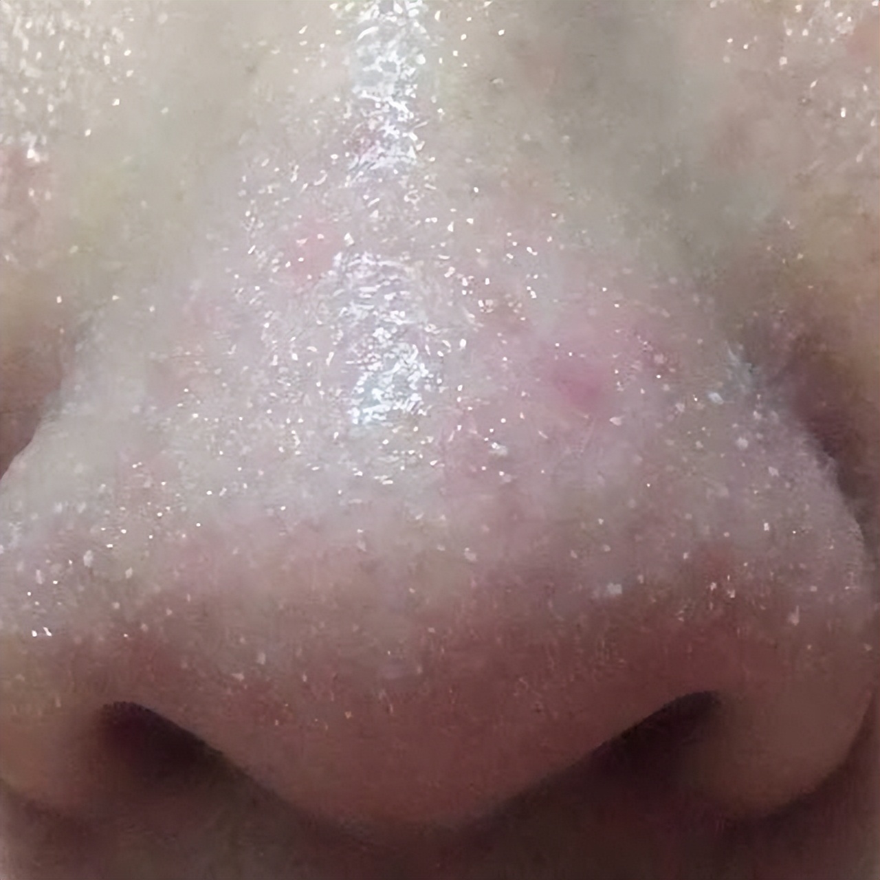 清洁面膜可以去黑头粉刺闭口吗,清洁面膜可以去除黑头吗