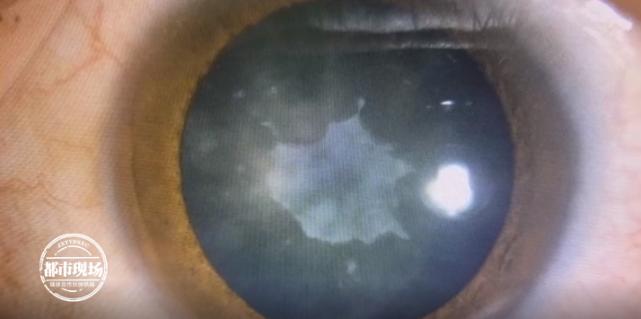 男子筋膜枪按摩眼睛患上白内障,用筋膜枪按摩眼睛险失明