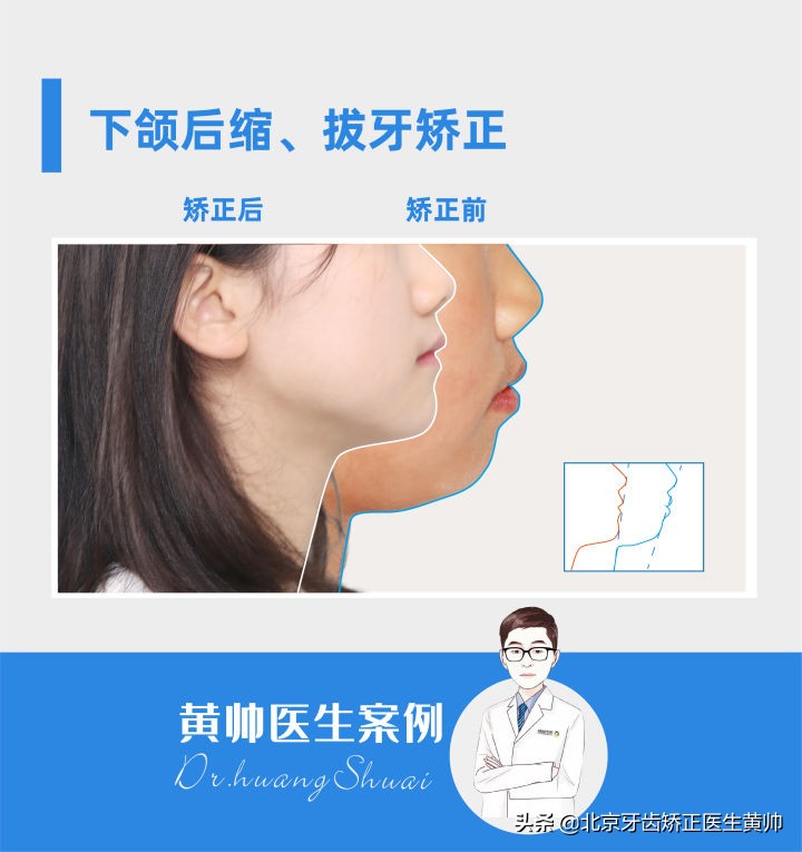 嘴凸的人怎么笑起来好看,嘴凸怎么让自己不焦虑