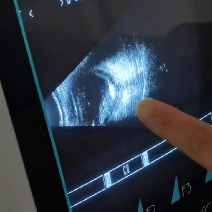 眼底超声检查视网膜裂孔,眼科b超能看出视网膜脱落吗