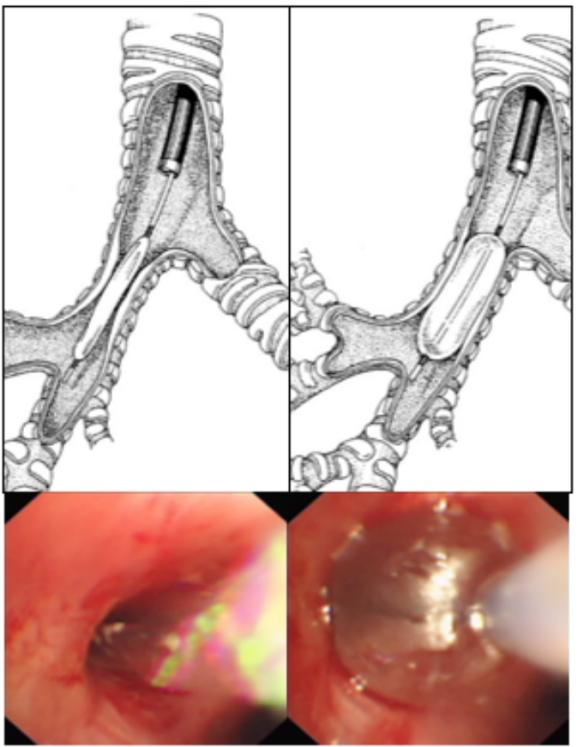 咯血一定要做支气管镜吗,支气管镜的注意事项