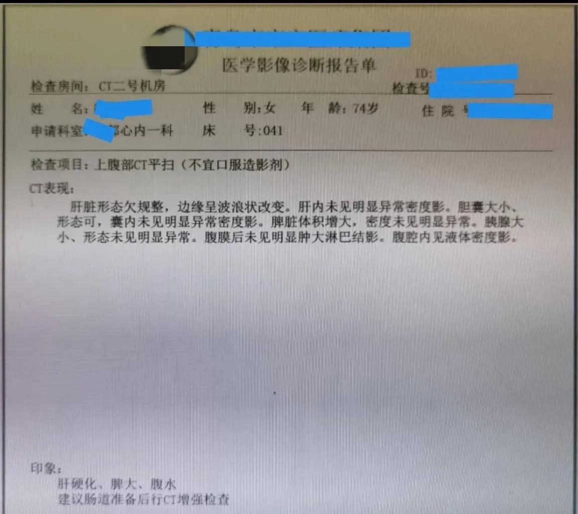 双下肢水肿心源性,心衰双下肢水肿
