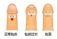 到底需不要割包皮,吻合器包皮环切术多少钱