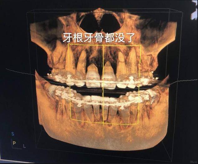 牙根腐烂要怎么治疗才可以恢复,牙根腐烂怎么治疗最快