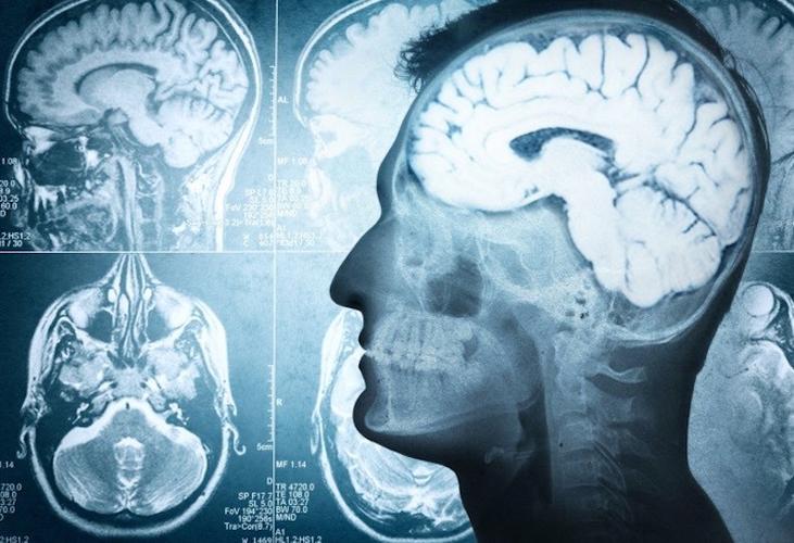 老年患者术后认知功能障碍麻醉相关因素及研究进展