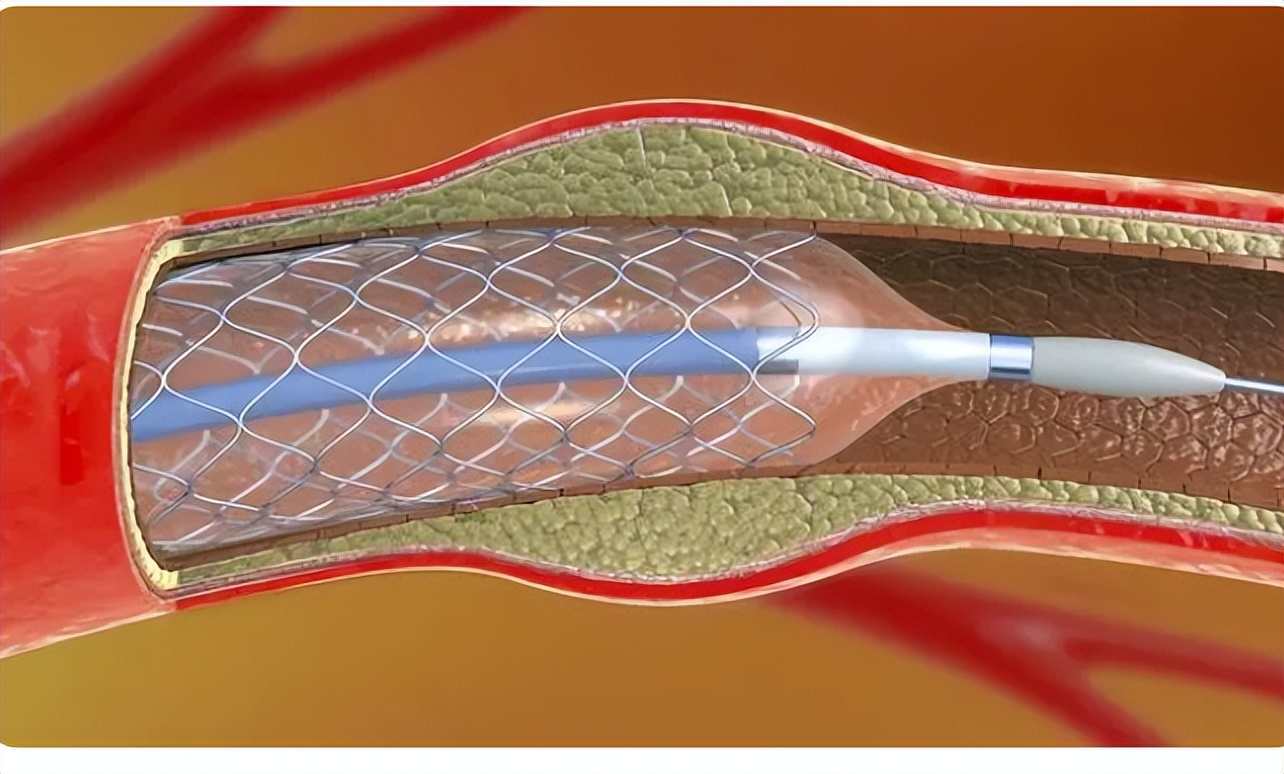 心脏支架手术一般能活多少年,做了心脏支架正常情况能活多少年