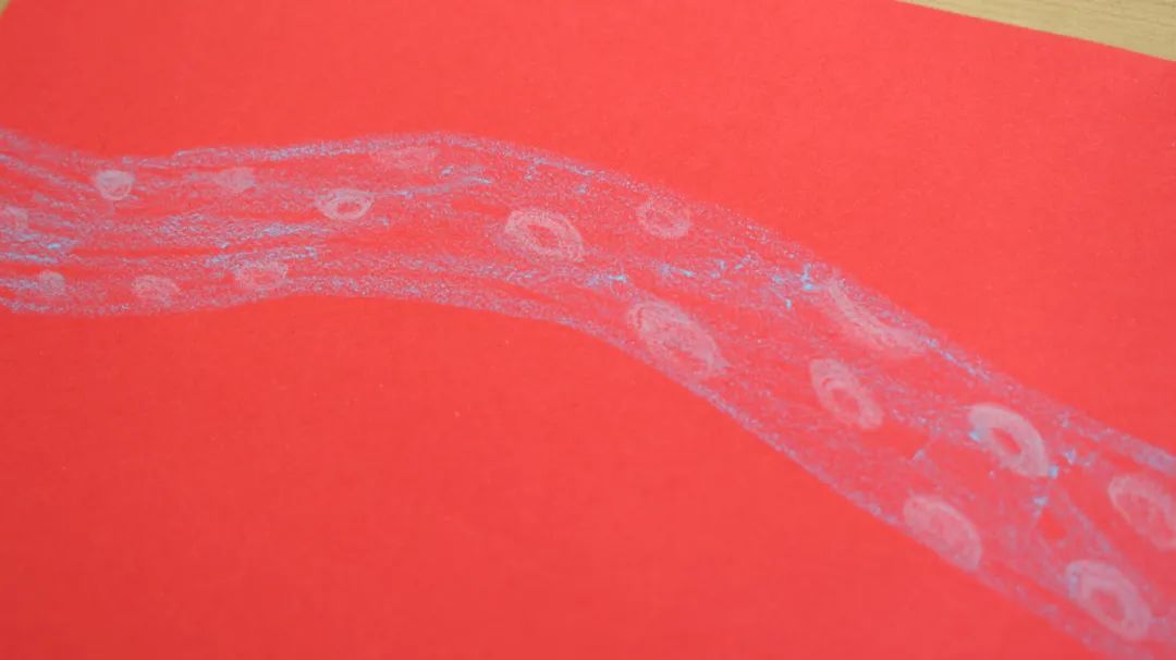 得了静脉曲张应该忌口吗,得了静脉曲张应注意些什么