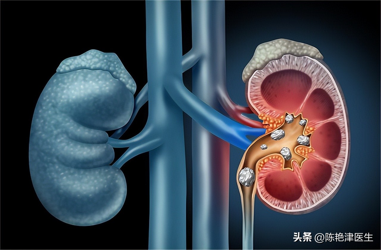 体检查出有肾结石要注意什么,体检有肾结石应该怎么处理