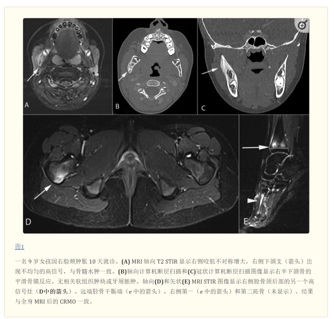 慢性骨髓炎症状,慢性复发性多灶性骨髓炎