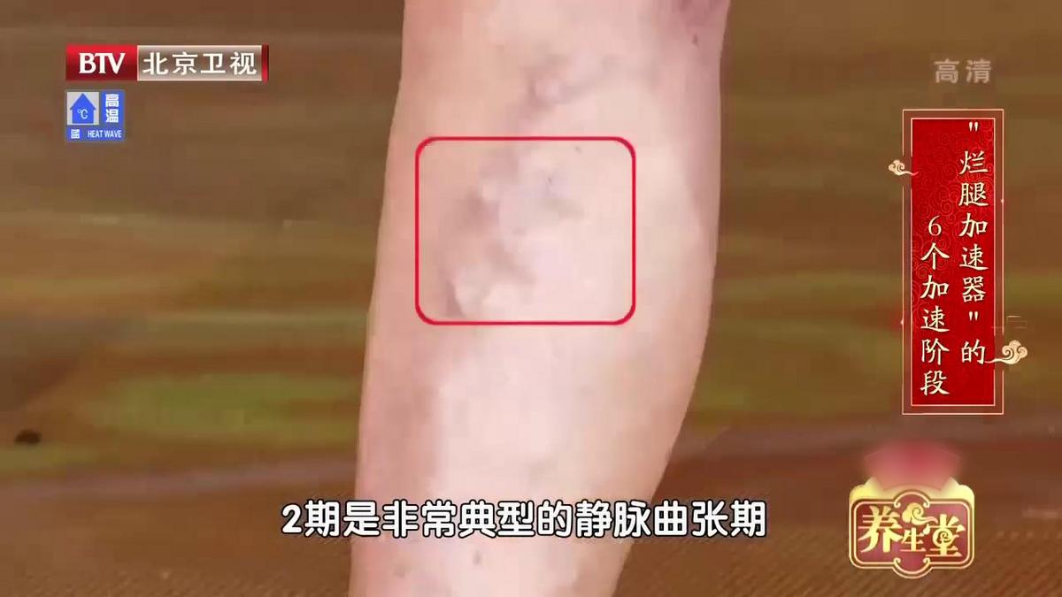 单腿小腿酸胀发麻是静脉曲张吗,腿酸胀难受怎么缓解静脉曲张