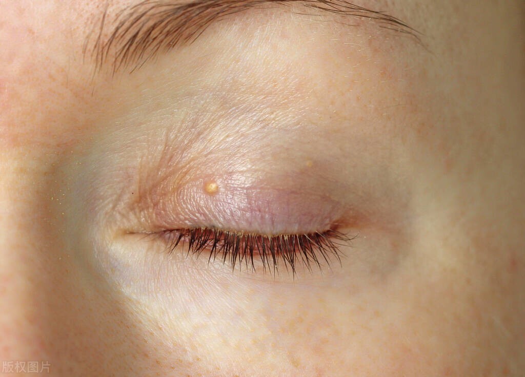 眼角褐青斑如何去除,脸色暗黄黄褐斑怎么调理最有效