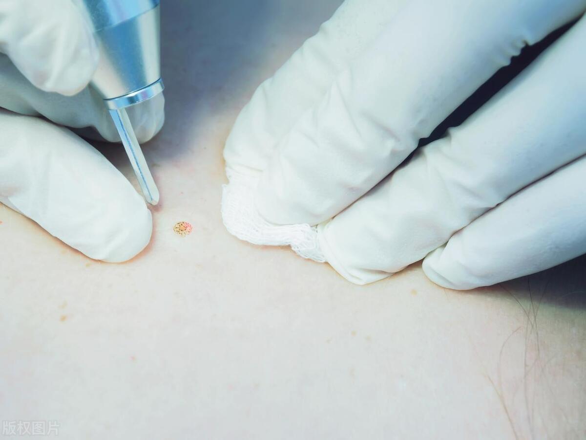 身上长满小肉粒怎么办,身上长出小肉粒可以掐掉吗