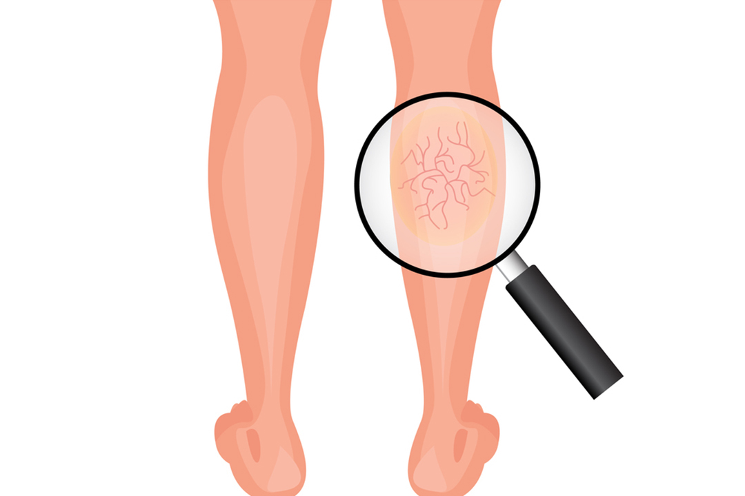 对静脉曲张最好的锻炼方法,下肢静脉曲张治疗方法及锻炼方法