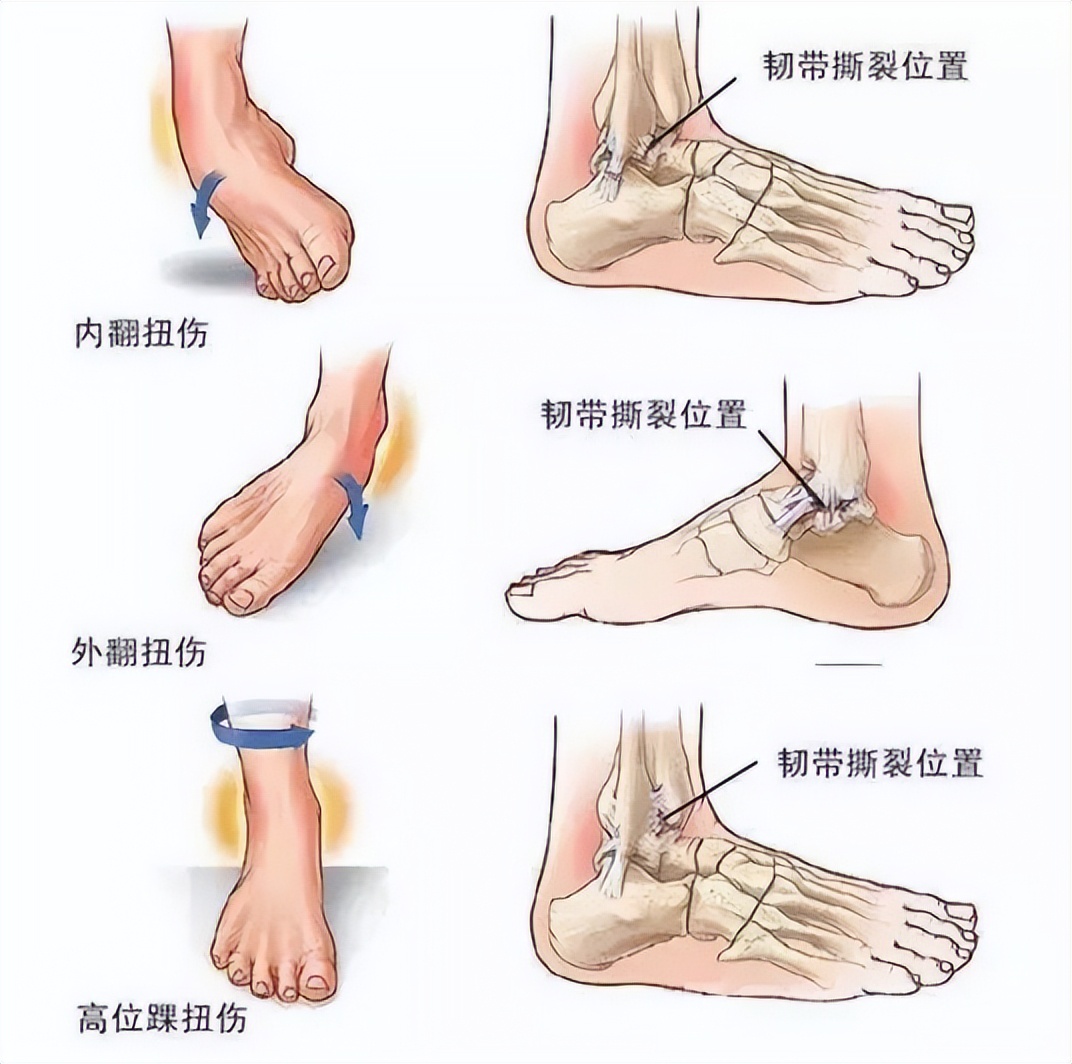 冉冉运动康复训练视频,踝关节康复斜板站立训练方法