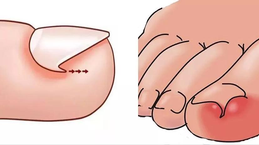 甲沟炎如何快速拔出脚趾甲,脚趾甲老往肉里钻一碰还疼