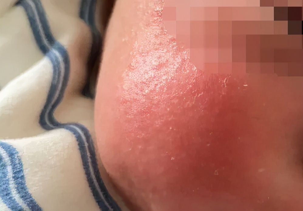 脸上起疹子擦宝宝霜,最近曝光的宝宝霜