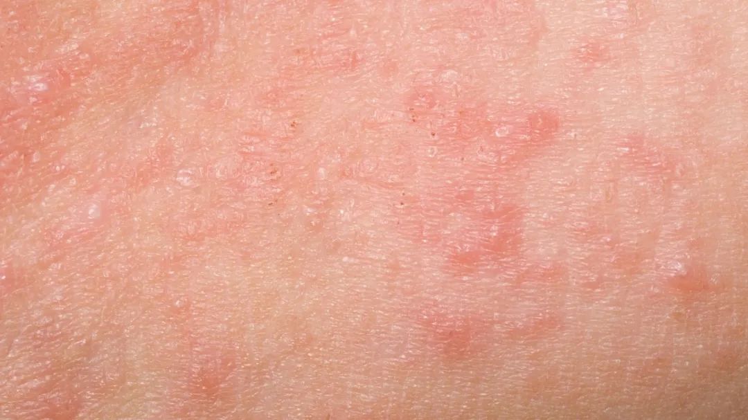 过敏体质反反复复的过敏该怎么办,过敏反复肌肤怎么修复