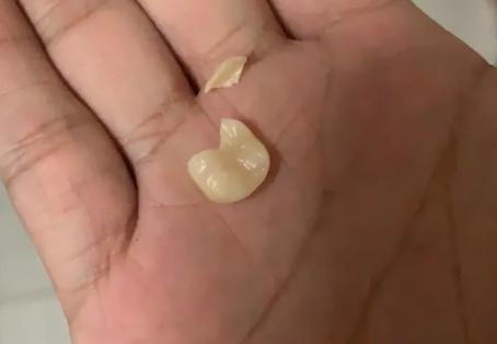 戴假牙套的牙活动了怎么办,假牙套的危害有哪些