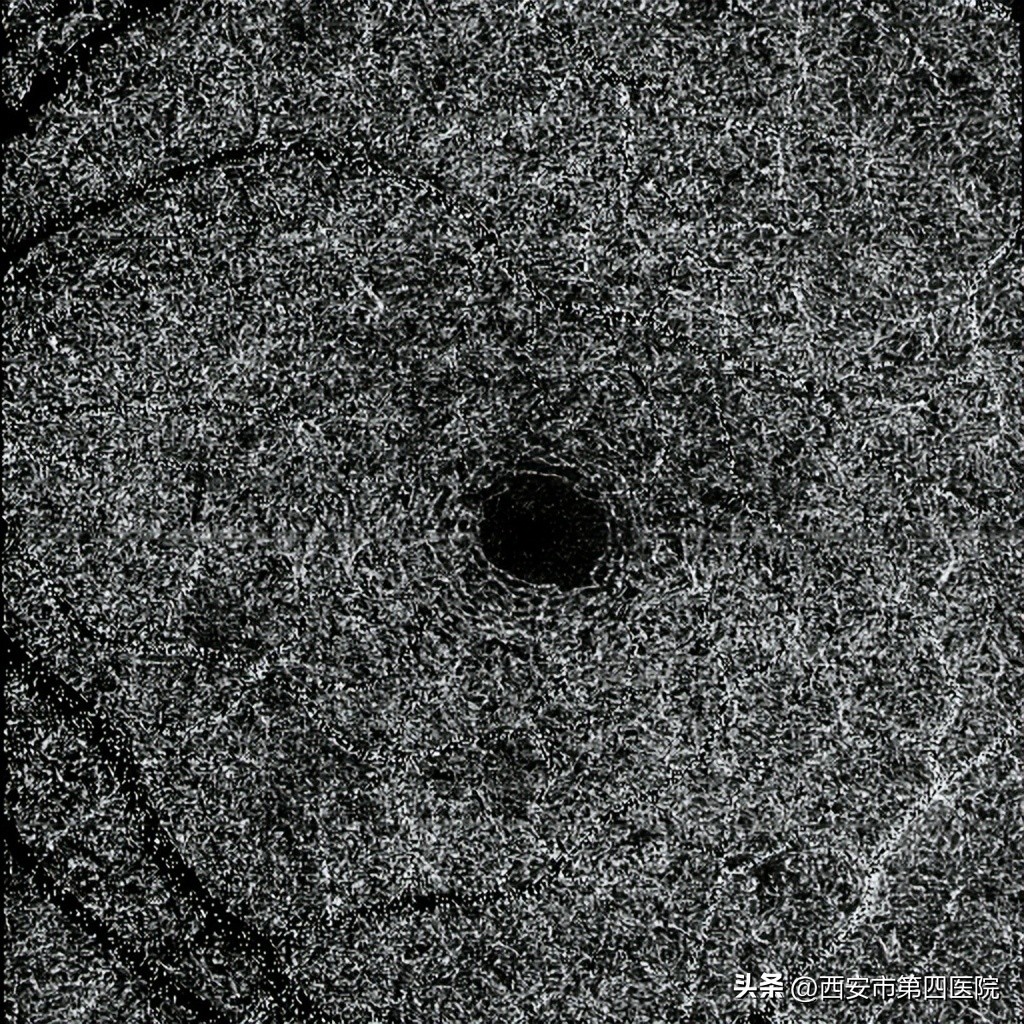 #新冠防疫手册#33岁女士“阳康”后视力下降、模糊、黑影……