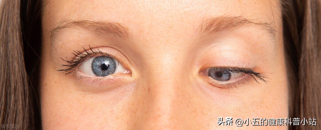 重症肌无力上眼睑下垂怎么描述,重症肌无力眼睑下垂严重程度分级