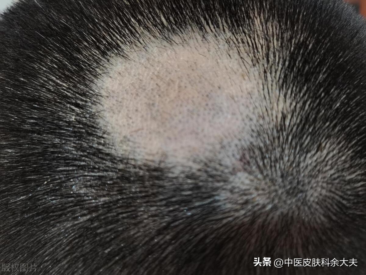 脱发严重时不妨试试以下三招,脱发是不是世界难题