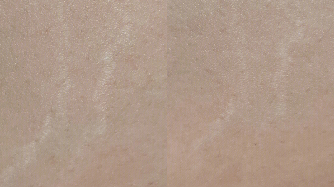 胳膊和大腿上的肥胖纹怎么能消掉,大腿有肥胖纹有十年了还能去掉吗