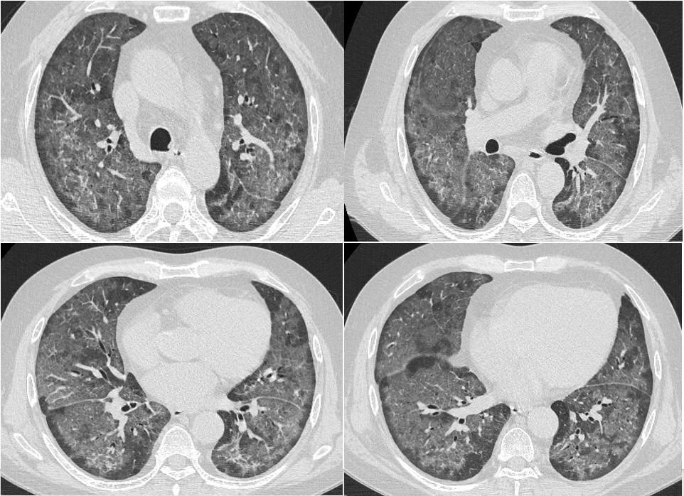 hiv感染肺孢子菌肺炎,hiv患者检查出耶氏肺孢子菌