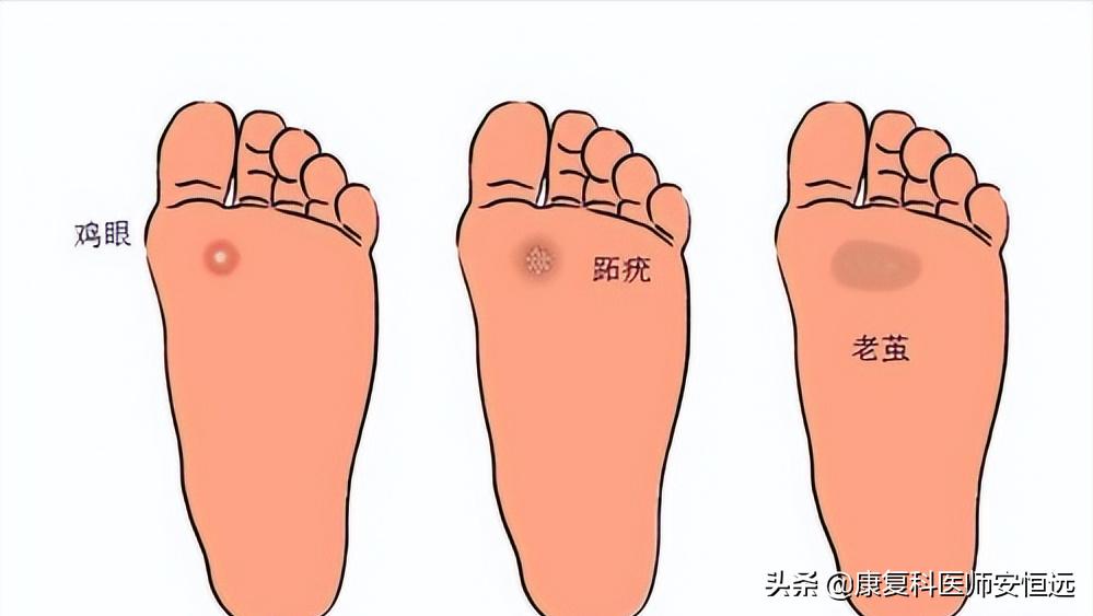 脚底板前面长茧子很疼怎么治疗,脚底板长很厚茧子疼怎么去除