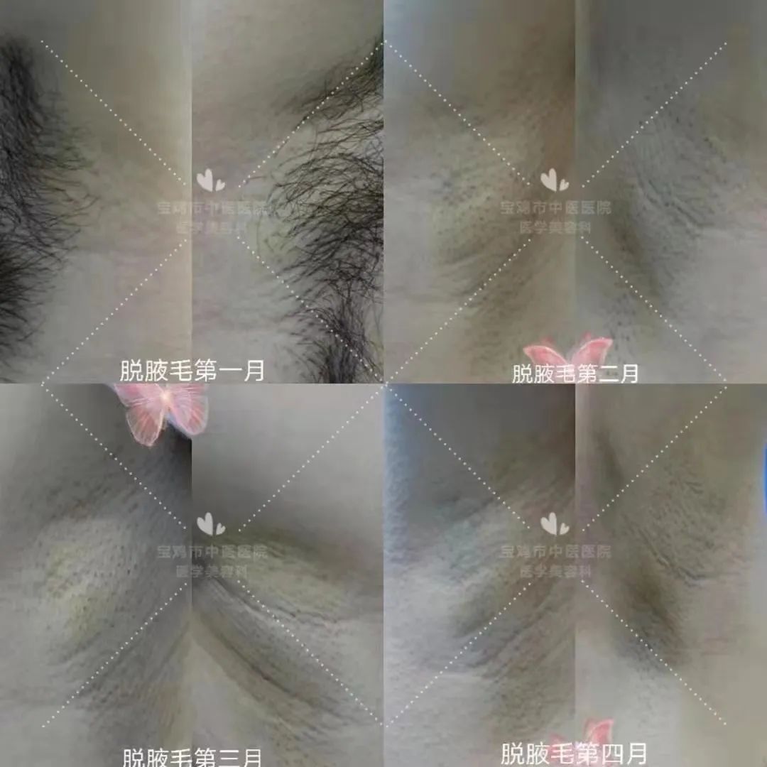 哪种脱毛方法永久脱毛不会再长毛,脱毛小妙招不伤皮