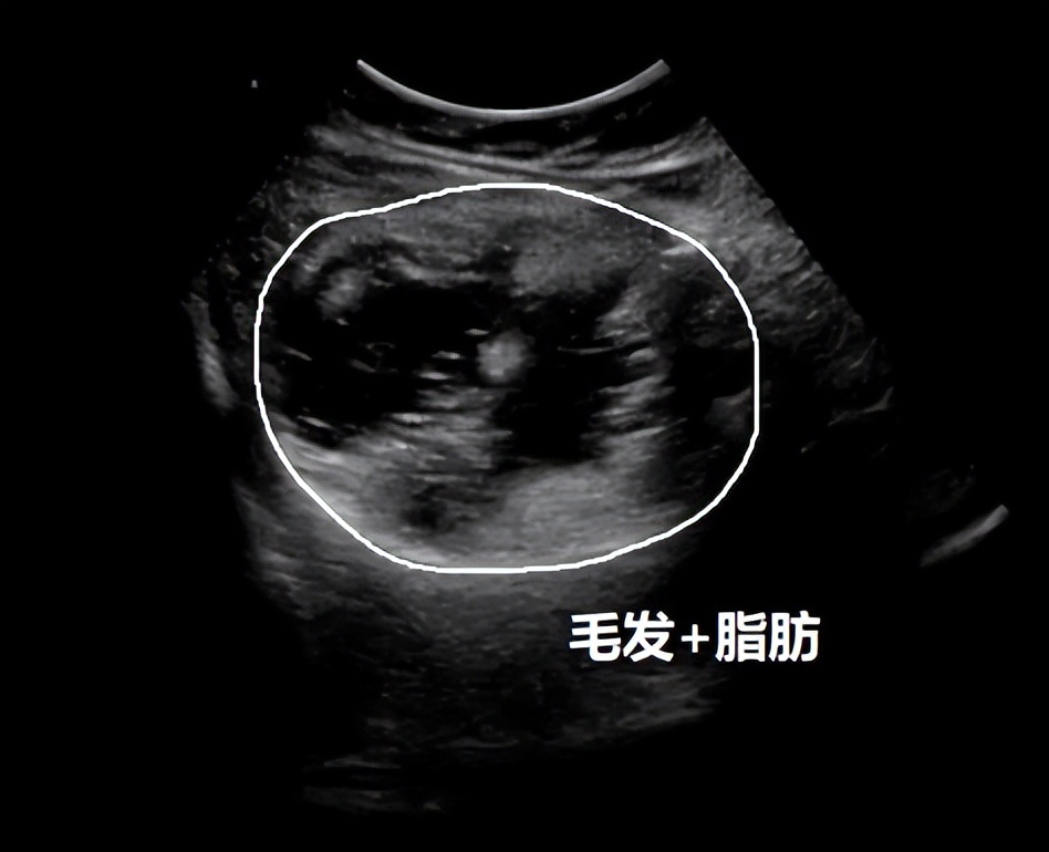 卵巢囊肿超声穿刺手术怎么做的,黄体囊肿与卵巢囊肿的超声区别