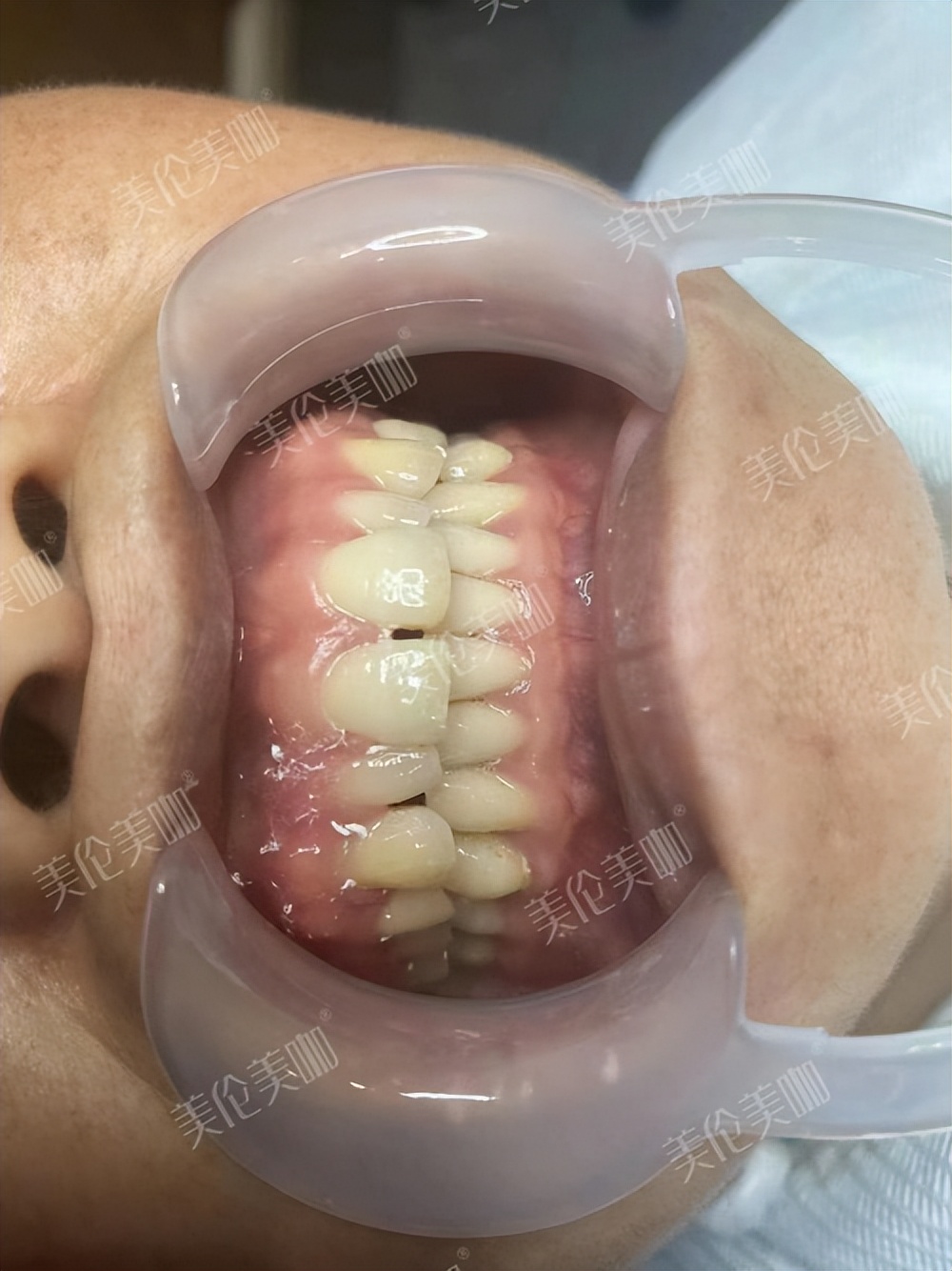 牙缝大做过贴面拆下来还能戴牙套,牙缝大做了两颗全瓷牙现在好后悔