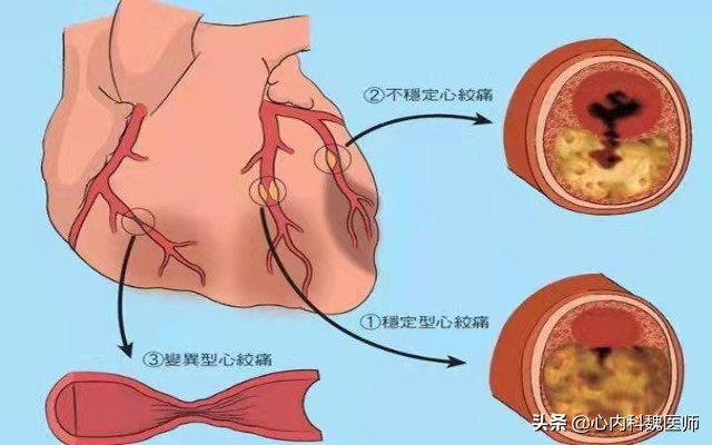 心肌缺血吃什么药效果更好,心肌缺血一般吃什么药可以缓解