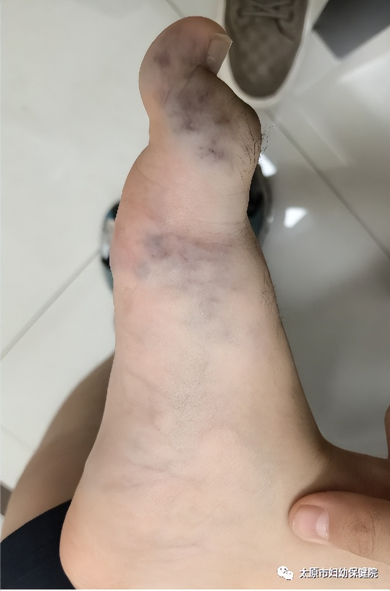 西安哪个医院治静脉畸形比较好,沈阳治疗静脉畸形