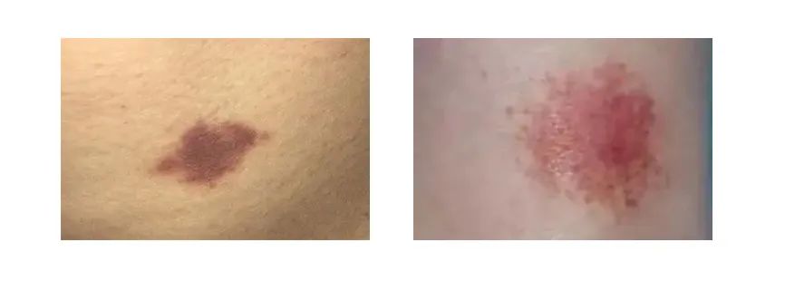 老公身上有吻痕可作为出轨证据吗,吻痕是出轨证据吗